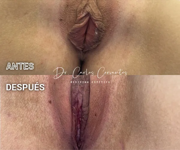 Img-Dr_Carlos_Cervantes-Antes&Despues-Labioplastia-2